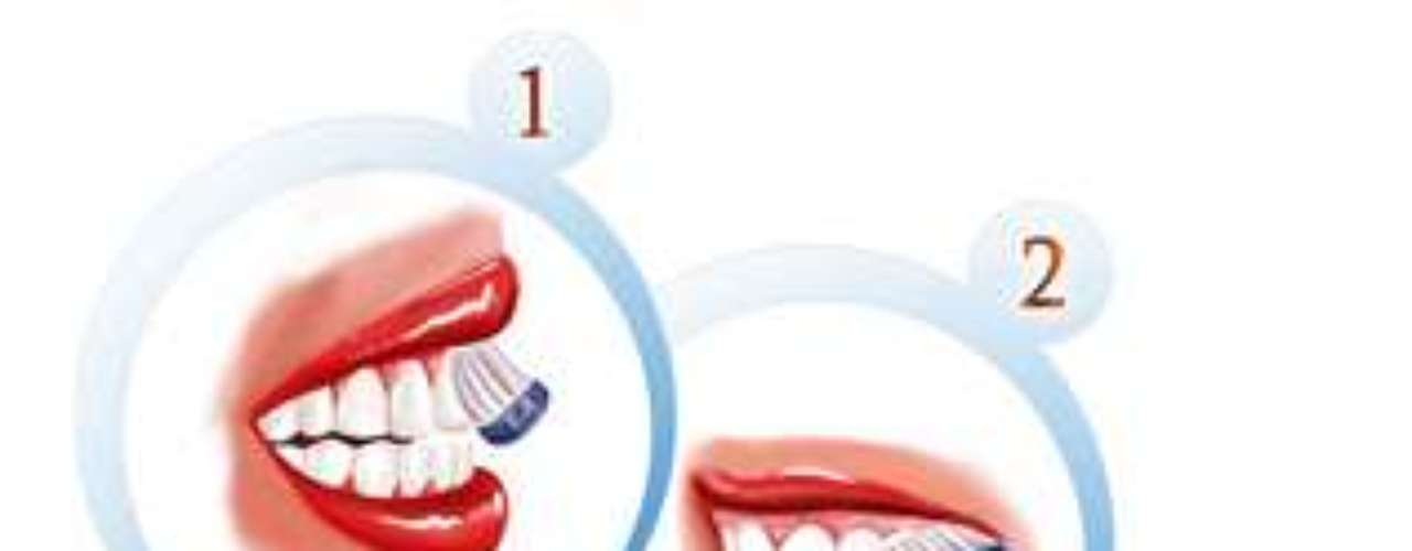 Passo 3 - Técnica de escovação - Faça movimentos vibratórios circulares com uma inclinação de 45 graus em relação à superfície dos dentes. As cerdas das escovas ficarão metade recobrindo a superfície dental e metade recobrindo a gengiva. Dessa forma é possível atingir o sulco gengival, região onde a sujeira mais se acumula. Estes pequenos movimentos vibratórios circulares devem ser executados por pelo menos 10 vezes em cada face do dente - parte de fora e parte de dentro. Esta técnica não pode em hipótese alguma ser realizada com escovas duras e sim do tipo ultramacias com uma grande quantidade de cerdas. Caso contrário, pode ocorrer retração gengival e abrasão do esmalte.