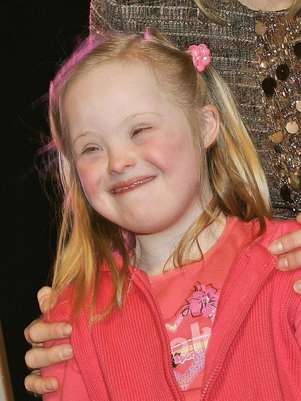 A síndrome de Down é causada pela presença de três cromossomos 21, ao invés de dois Foto: Getty Images A síndrome de Down é causada pela presença de três cromossomos 21, ao invés de dois Foto: Getty Images