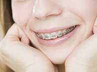 Se utilizan diversos tipos de aparatos, fijos y removibles, para mover los dientes, volver a entrenar los m&uacute;sculos y modificar el crecimiento de las mand&iacute;bulas.Foto: ThinkStock