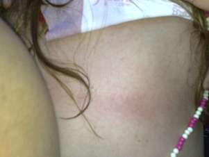 Nayanna mostra marcas no corpo após ser agredida por PM em Salvador Foto: Marcelo Miranda Becker / Terra