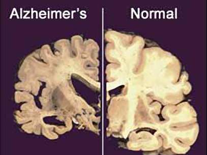 Esta imagen sin fechar suministrada por Merck & Co., muestra la sección transversal de un cerebro normal a la derecha y la de un cerebro dañado por la enfermedad de Alzheimer a la izquierda.  Foto: Merck & Co./Archivo / AP