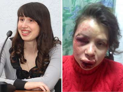 Rosto de Tetyana Chernovil ficou desconfigurado após agressão Foto: Twitter / Reprodução