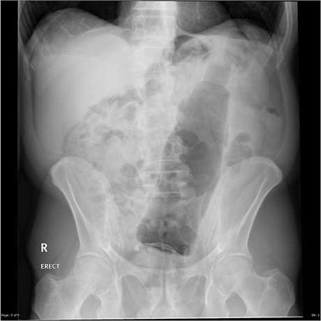 Uma garrafa é vista em radiografia Foto: The Mirror / Reprodução