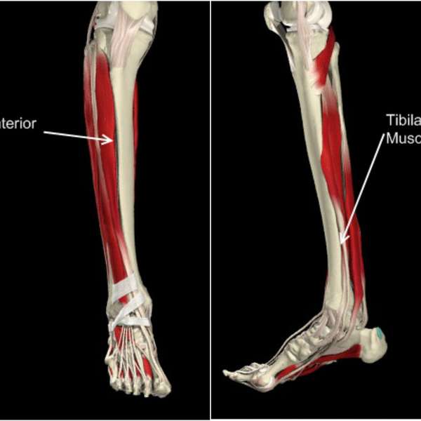 Lesiones periostitis tibial