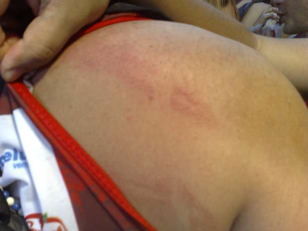 Foilão mostra marca vermelha nas costas após apanhar de PM em Salvador Foto: Marcelo Miranda Becker / Terra