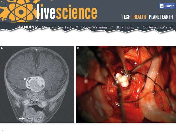 O dente teria sido produzido por um tumor de tipo bastante raro, segundo informações do site Live Science Foto: Reprodução O dente teria sido produzido por um tumor de tipo bastante raro, segundo informações do site Live Science Foto: Reprodução