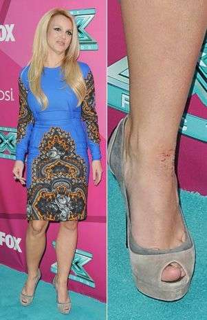 Kim Kardashian transmite su vida en directo, sus alegrías y sus penas y hasta sus enfermedades. La celebrity padece psoriasis y no dudó en publicar fotos de su piel afectada por esta enfermedad. Gracias a un tratamiento de 2.000 euros, KimKa se encuentra mejor de este último brotes. El estrés suele ser el principal motivo para que la piel se enrojezca. Foto: Foto: Peru.com