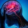 Epilepsia: mitos e verdades sobre a condição neurológica