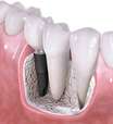 ¿Cuántos tipos de implantes dentales existen?