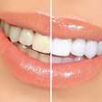 Endógeno, mixto, casero.. Conozca los tipos de blanqueamiento dental