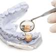 ¿Qué Son los Implantes Dentales?