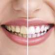 ¿En qué Consiste el Blanqueamiento de los Dientes?