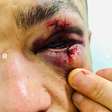 Ex-campeão do UFC mostra olho desfigurado após nocaute