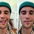 Paralisia facial: o caso Justin Bieber e outras causas e tratamentos