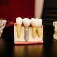 Prótese dentária em casa: os perigos da prática ensinada nas redes sociais