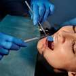 Facetas dentárias: Fique por dentro da técnica para não correr riscos