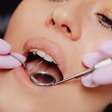 Clareamento dental: qual a técnica mais adequada para cada boca?