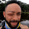 Ataque de vespas deixa Youtuber com rosto desfigurado