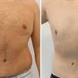 Abdominoplastia em homens exige cuidado extra no pós-operatório