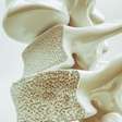 Osteoporose: 4 fatos para entender a doença