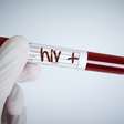 Pacientes com diagnóstico tardio de HIV têm 6 vezes mais chances de morrer