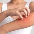 Alergias: 5 doenças de pele mais comuns no verão