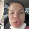 Nutricionista viraliza nas redes sociais ao exibir necrose após realizar preenchimento labial