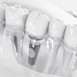 Implante zigomático traz nova alternativa na implantodontia