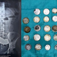 Fisiculturista engole 39 moedas e 37 ímãs para tentar absorver zinco