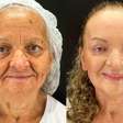 'Meus familiares não me reconheceram', diz mulher de 65 anos que fez peeling de fenol