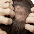 Calvície precoce: veja as causas de perda de cabelo entre os jovens