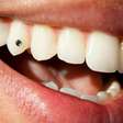 Uso de piercing no dente pode afetar a saúde bucal, diz especialista