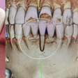 Por que a contenção higiênica nos dentes pode causar até a extração?