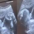 Bebê faz xixi durante ultrassom e vídeo surpreende a web; obstetra explica