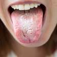 Saburra lingual: veja o que deixa a língua branca