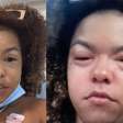 Jeniffer Nascimento faz alerta após ter reação alérgica com lagosta: 'Desesperador'