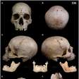 Crânio mostra como egípcios tratavam câncer há 4 mil anos