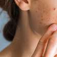 Dermatologista alerta sobre 5 erros ao tratar a acne
