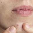 Minancora para acne: conheça 5 benefícios da pomada para as espinhas