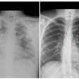 Diferença entre pulmão destruído por vape e órgão saudável surpreende em raio-x; veja