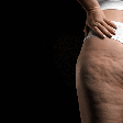 Lipedema: conheça tratamentos estéticos para controlar condição