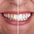 Para clarear os dentes de forma natural você deve adotar esses 4 truques na sua rotina