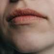 Lábios ressecados no verão? Veja como mantê-los saudáveis