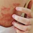 Dermatite atópica: conheça os sintomas e tratamento