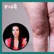 Lipedema: entenda quando a cirurgia plástica é indicada