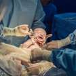 Vencendo o desafio do nascimento: vidas de milhões de bebês podem mudar com simples teste do cordão umbilical