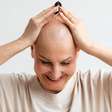 Alopecia feminina: como identificar os sinais e buscar tratamento