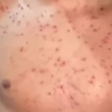 MPOX: Secretaria de Saúde de Pernambuco nega possível caso da doença em aluno