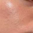 Pele oleosa? Dermatologista explica como deve ser rotina de skincare