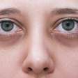 Olheiras: dermatologistas ensinam como tratar os diferentes tipos